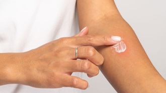 Braccio con puntura di insetto e crema